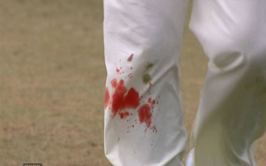 Ind Vs Eng Oval Test James Anderson Bowling With Bleeding Knee