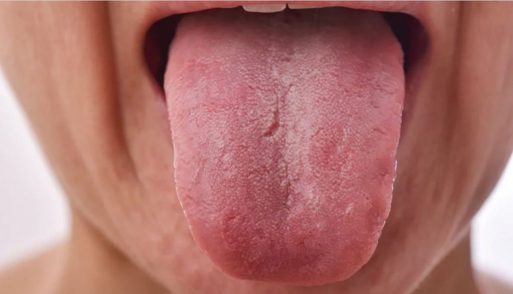 These Are The Reason Behind White Spot On Your Tongue