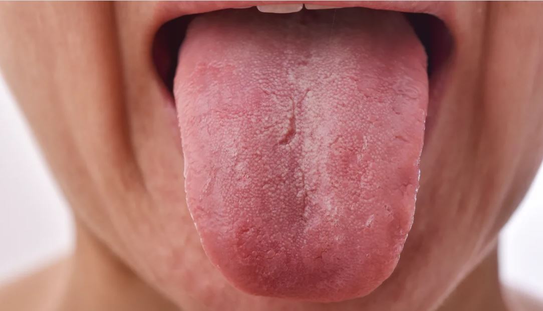 These Are The Reason Behind White Spot On Your Tongue These Are The Reason Behind White Spot On Your Tongue