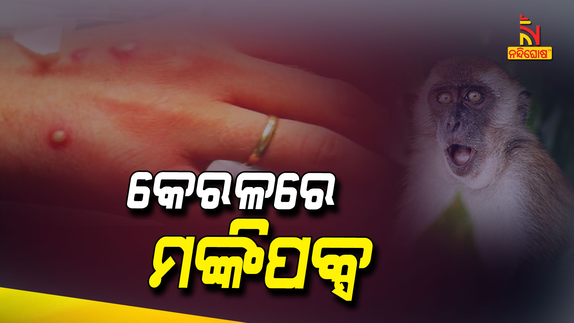 କେରଳରେ-ମଙ୍କିପକ୍ସ