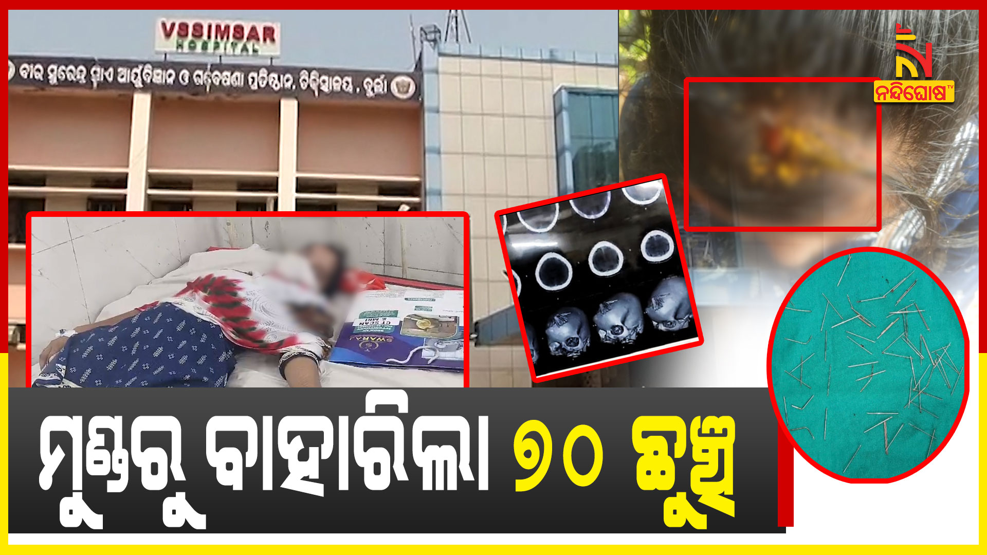 ମୁଣ୍ଡରୁ-ବାହାରିଲା-୭୦-ଛୁଞ୍ଚି