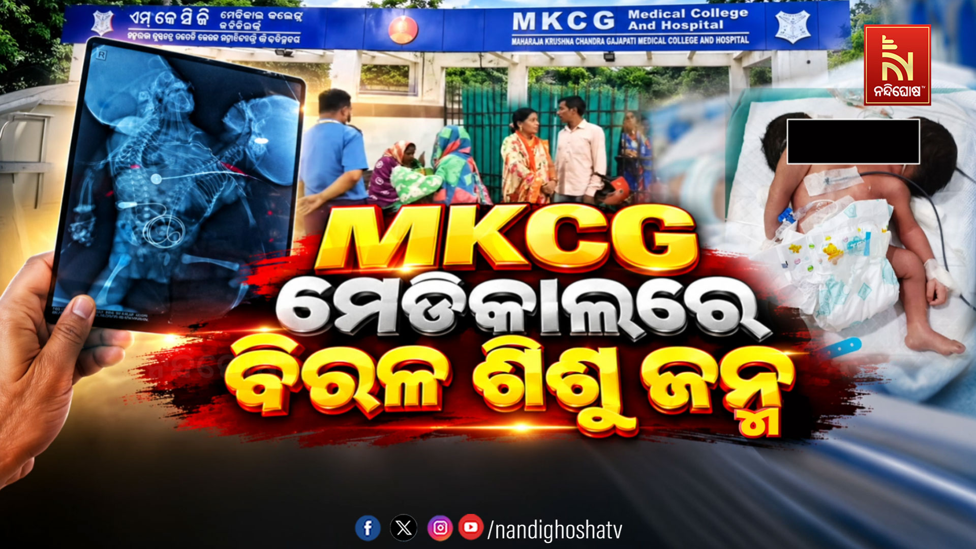 ଦୁଇଟି ମୁଣ୍ତ, ଗୋଟିଏ ଶରୀର: ଏମକେସିଜି ମେଡ଼ିକାଲରେ ବିରଳ ଶିଶୁ ଜନ୍ମ