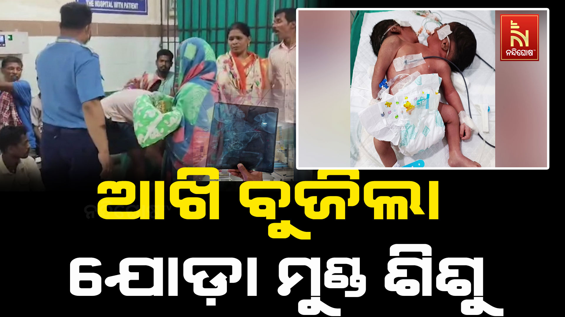 ଆଖି ବୁଜିଲେ ଯୋଡ଼ା ମୁଣ୍ଡ ଶିଶୁ